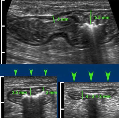 measurement of small intestine thickness|The Radiology Assistant : US of the GI tract .